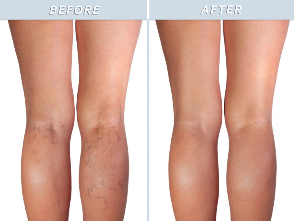Healthy leg and the affected varicose veins