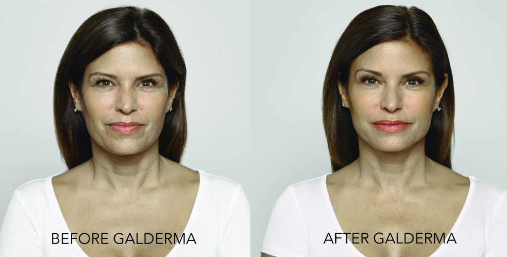 Before and After_Victoria